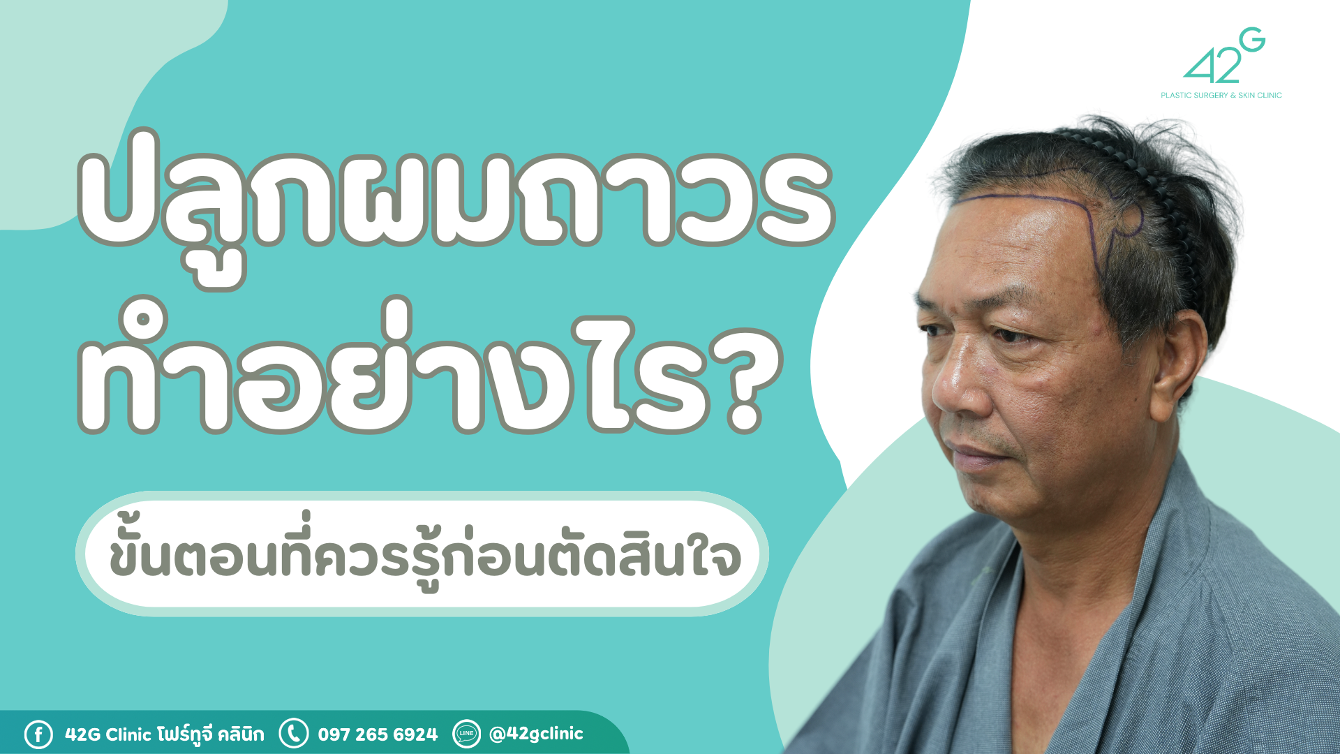 ปลูกผมถาวรทำอย่างไร? ขั้นตอนที่ควรรู้ก่อนตัดสินใจ